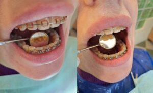 Higienizacja w trakcie leczenia ortodontycznego